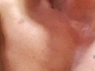 Acestesi187